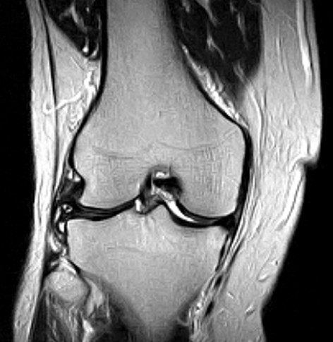 Knee Coronal MRI scan
